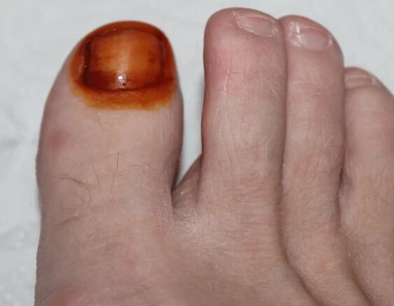 Behandlung von Pilzjod