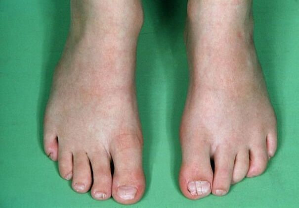 Der Pilz in den Beinen