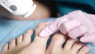 Beinpilz -Hardwarebehandlung