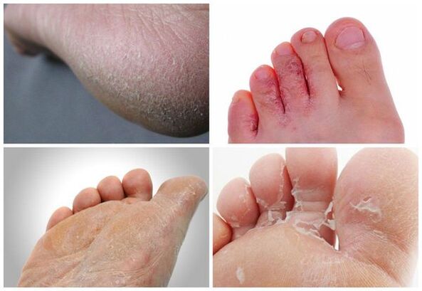 Die Haupterscheinungen einer Mykose der Füße sind Verhornung der Haut, Risse und Peeling.