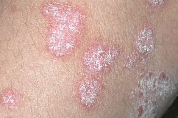 Psoriasis, verursacht durch eine Pilzinfektion
