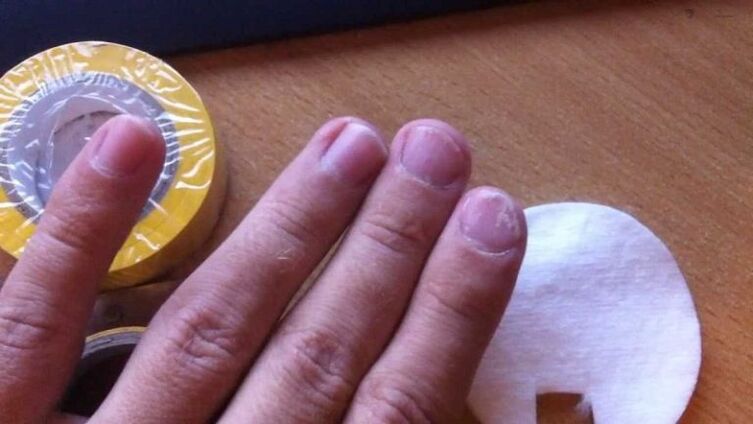 Nagelpilz und seine Behandlung mit Hausmitteln