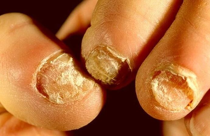 Nagelpilz, wie man behandelt