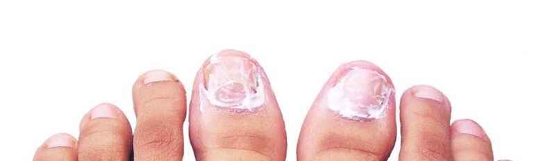Nagelsalbe gegen Pilze