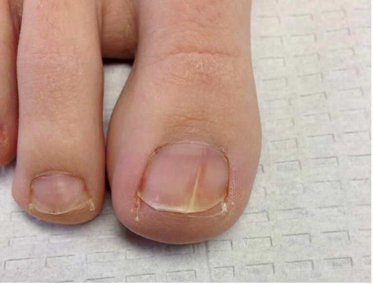 Pilzinfektion der Nagelplatte