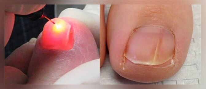 Lasertherapie